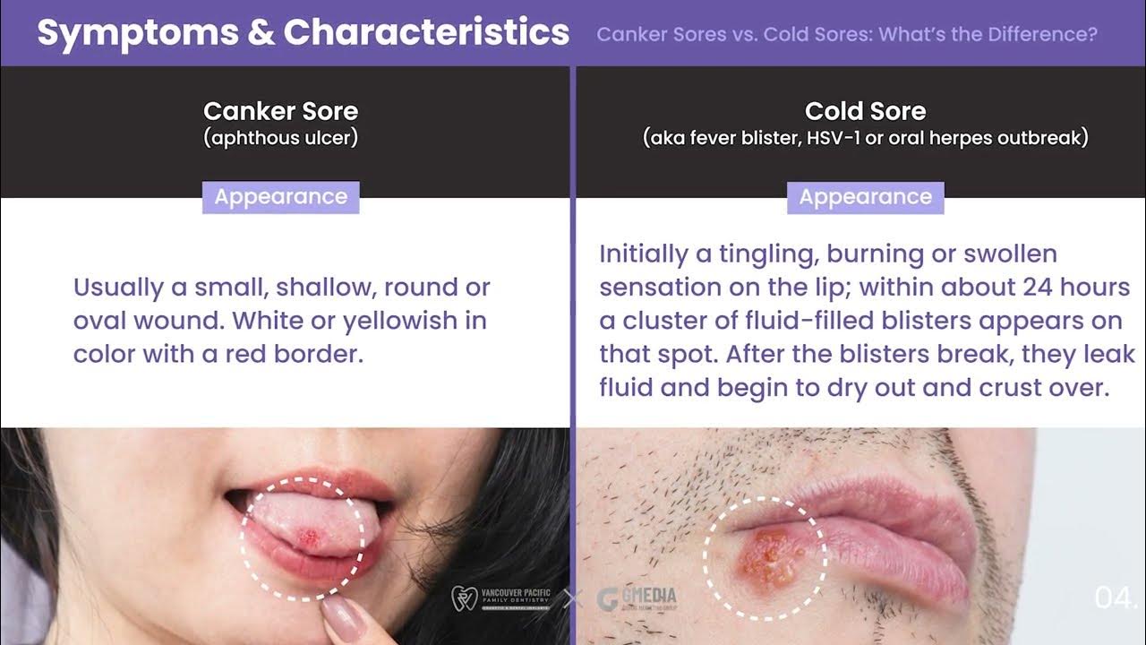 vancouver-pacific-family-storytelling-canker-sores-vs-cold-sores