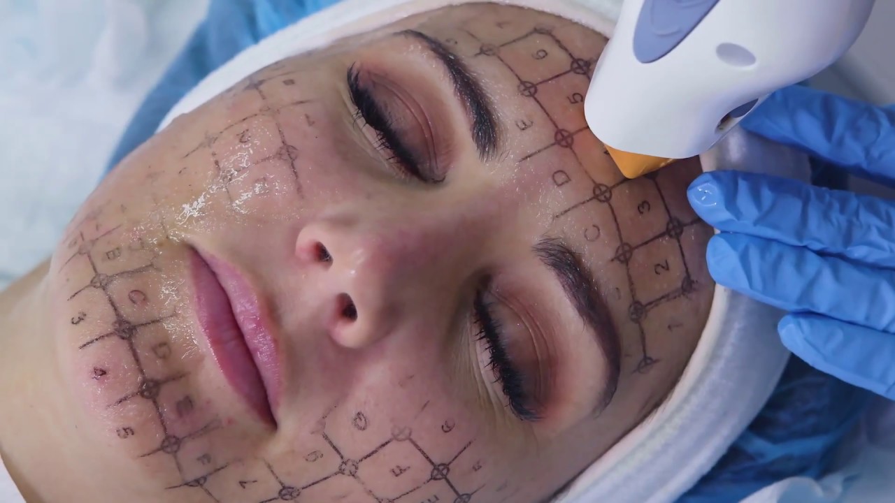 Thermage Skin Tightening | The Clinic Bondi Junction