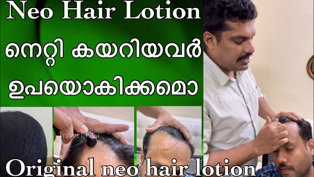 നെറ്റി കയറിയവർക്ക് Neo Hair Lotion എങ്ങിനെ ഉപയോഗിക്കാം how to use neo