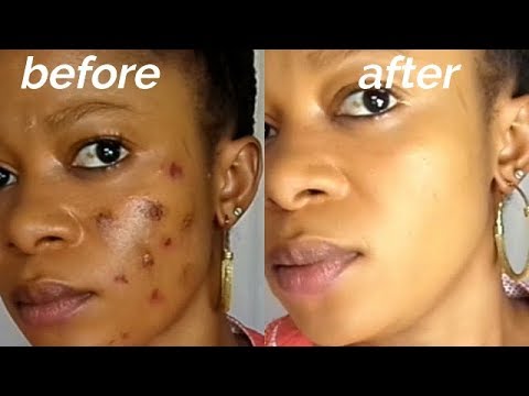 Remove Pimples Acne And Dark Spots Overnight With Very Strong Acne Treatment