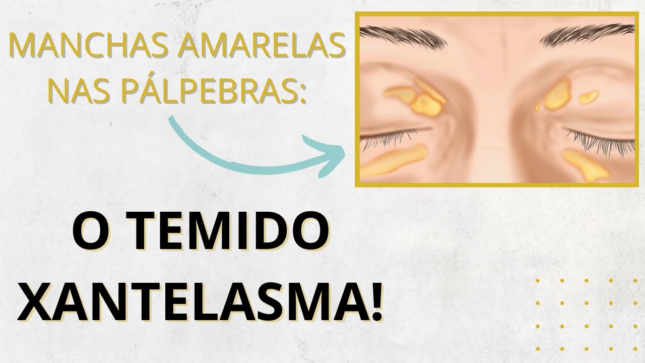 Manchas amarelas nas pálpebras Xantelasma o que é e como tratar YouTube