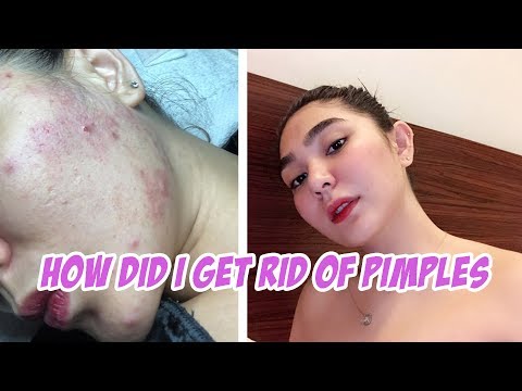 SKINCARE by ABBIE TOLENTINO. (PCOS AND SKIN ISSUES)