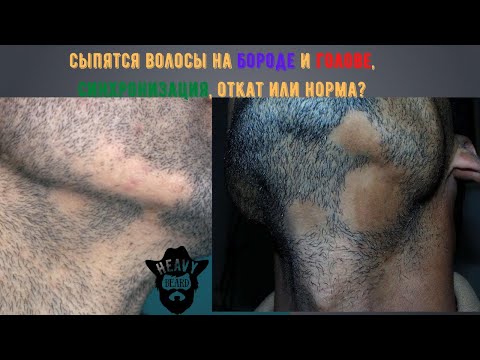 Сыпятся волосы, бородопад и волосопад от минокса