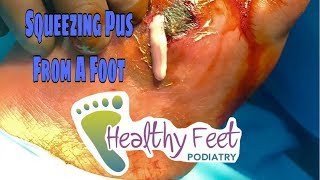 Squeezing pus out of a foot