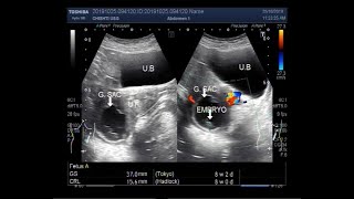 Ultrasound Video showing Early pregnancy with fetal demise.