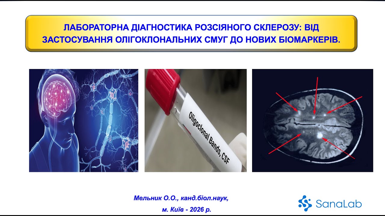 Лабораторна діагностика розсіяного склерозу
