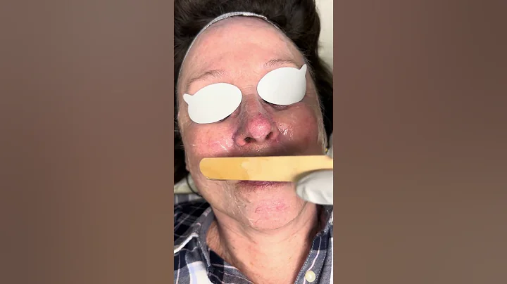 IPL Treatment From Start To Finish | Spectrum Dermatology of Atlanta | Alpharetta, Roswell, Cumming