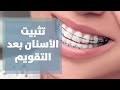 مرحلة تثبيت الأسنان بعد التقويم