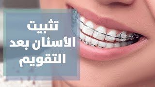 مرحلة تثبيت الأسنان بعد التقويم