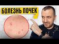 17 признаков, что с почками не всё в порядке — не игнорируйте эти сигналы