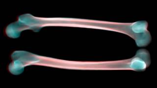 Multiview atlas-based 2D/3D registration of femoral bone