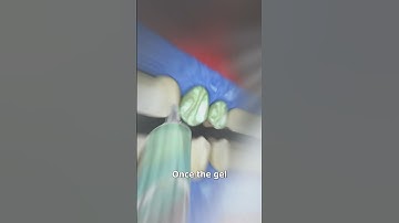 Professional Teeth Whitening 🤔 (explained)