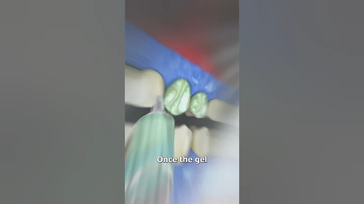 Professional Teeth Whitening 🤔 (explained)