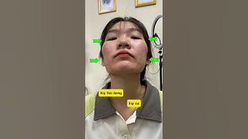 Trị liệu mặt lệch, hóp má, hóp thái dương, gò má cao,... liệu trình chuyên sâu cho người ở xa