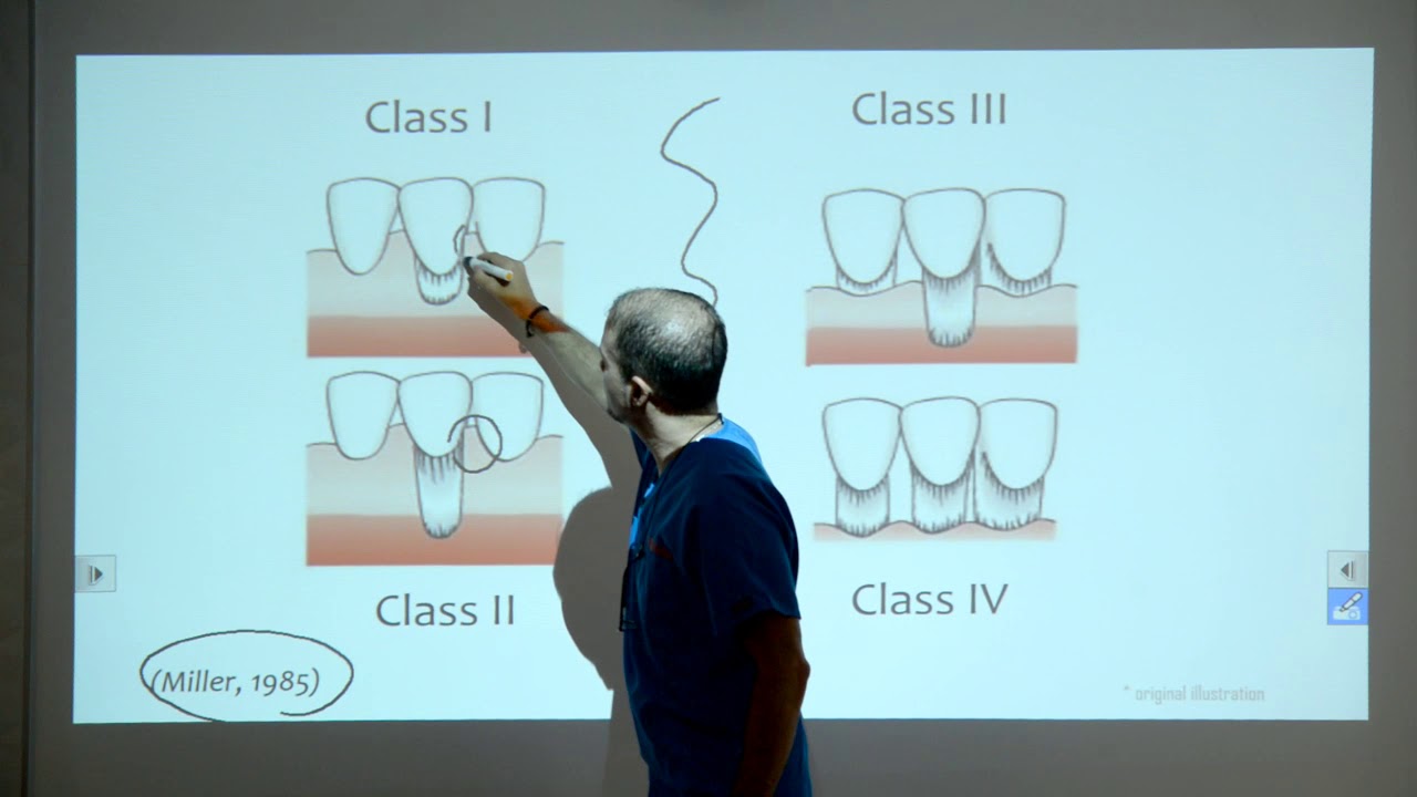 (Ep 02) Quais recessões gengivais podem ser tratadas?