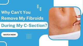 Why Can't You Remove My Fibroids During My C-Section? - TheFibroidDoc