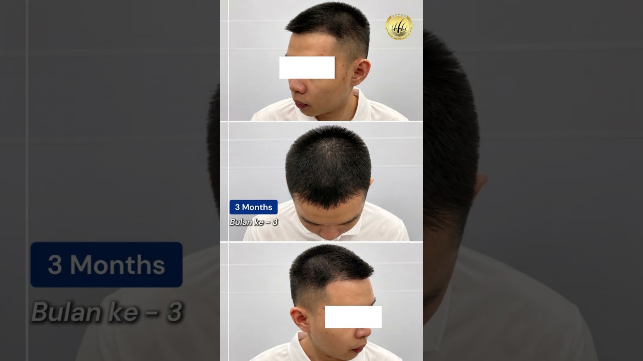 Hair Transplant Malaysia l Pakar Tanam Rambut l M-shaped hairline transformation!