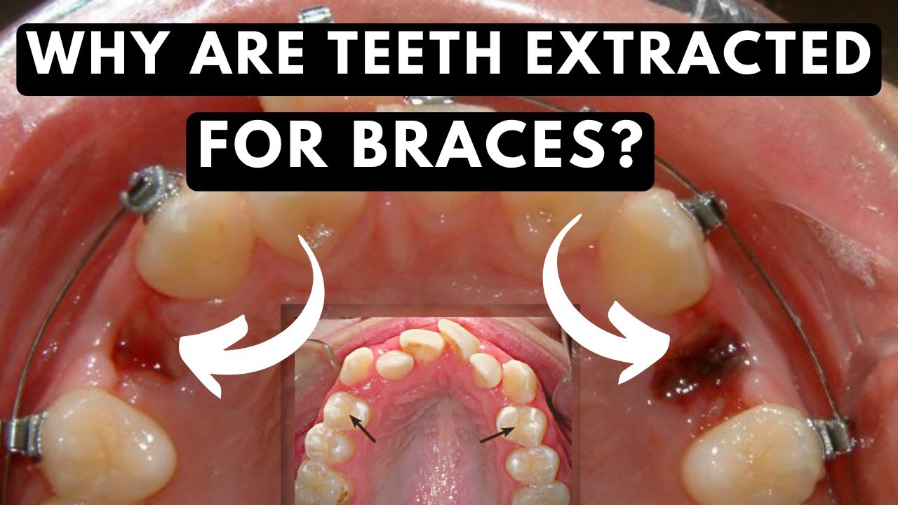 Removing Teeth For Braces Know Why Your Teeth Are Extracted YouTube