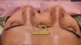 Nonsurgical correction of Crooked Nose