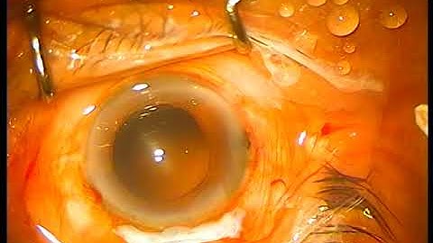 Fishhook technique on mature cataract
