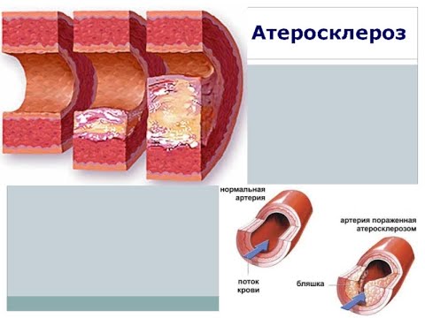 2 №5 АТЕРОСКЛЕРОЗ  ПРОФИЛАКТИКА И ЛЕЧЕНИЕ.  ГИПОЛИПИДЕМИЧЕСКИЕ СРЕДСТВА