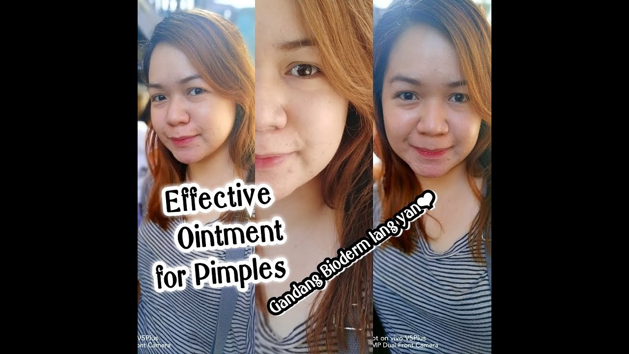 Vlog 8 Bioderm Ointment for Acne😍 YouTube