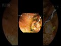 ERCP in an IVF Triplet Pregnancy with Choledocholithiasis