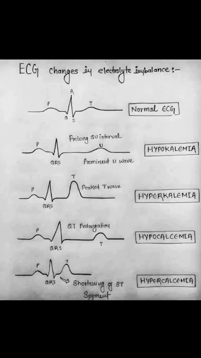 ECG changes
