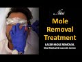 Laser Mole Removal | Face Mole Removal Treatment | Nitai Cosmetics Melbourne