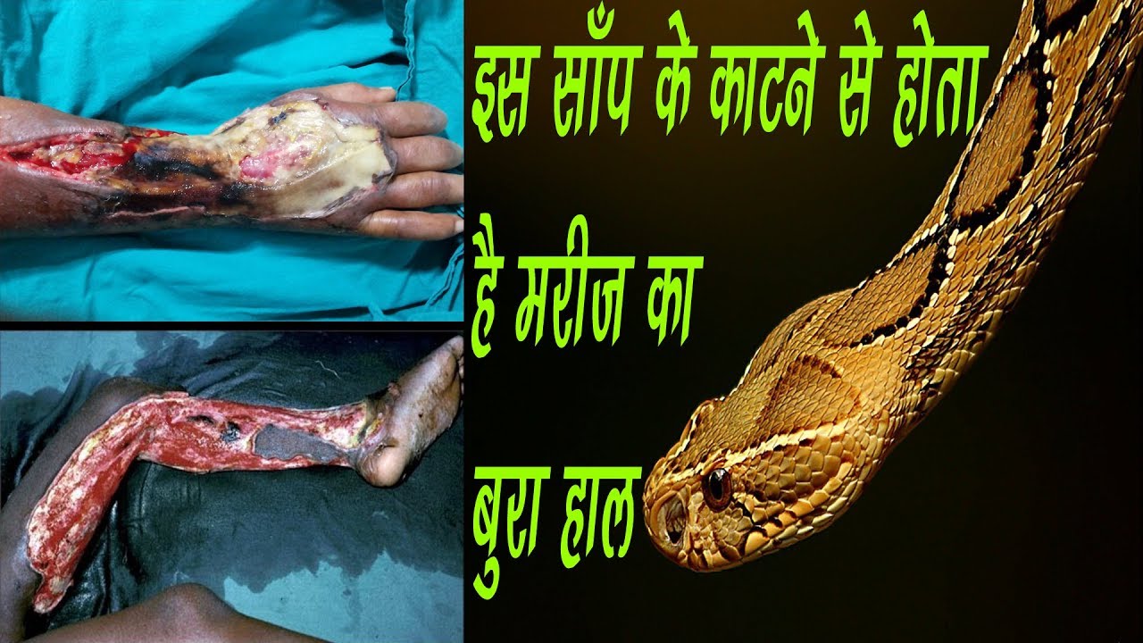 snake rescue team viper | सुविधा के आभाव ने मरीज का हुआ बुरा हाल |Kamal choudhary contact No. 9755695959
