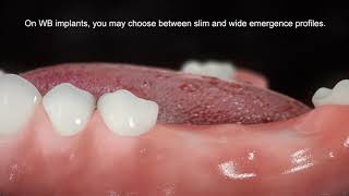 Straumann® BLX Implant System - Slim & Wide