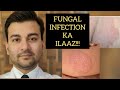 फ़ंगल इन्फ़ेक्शन का इलाज। Fungal infection Permanent Solution explained by Dr Animesh