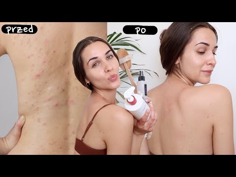 BACNE SKINCARE ROUTINE | jak pozbyć się trądziku na plecach | pielęgnacja