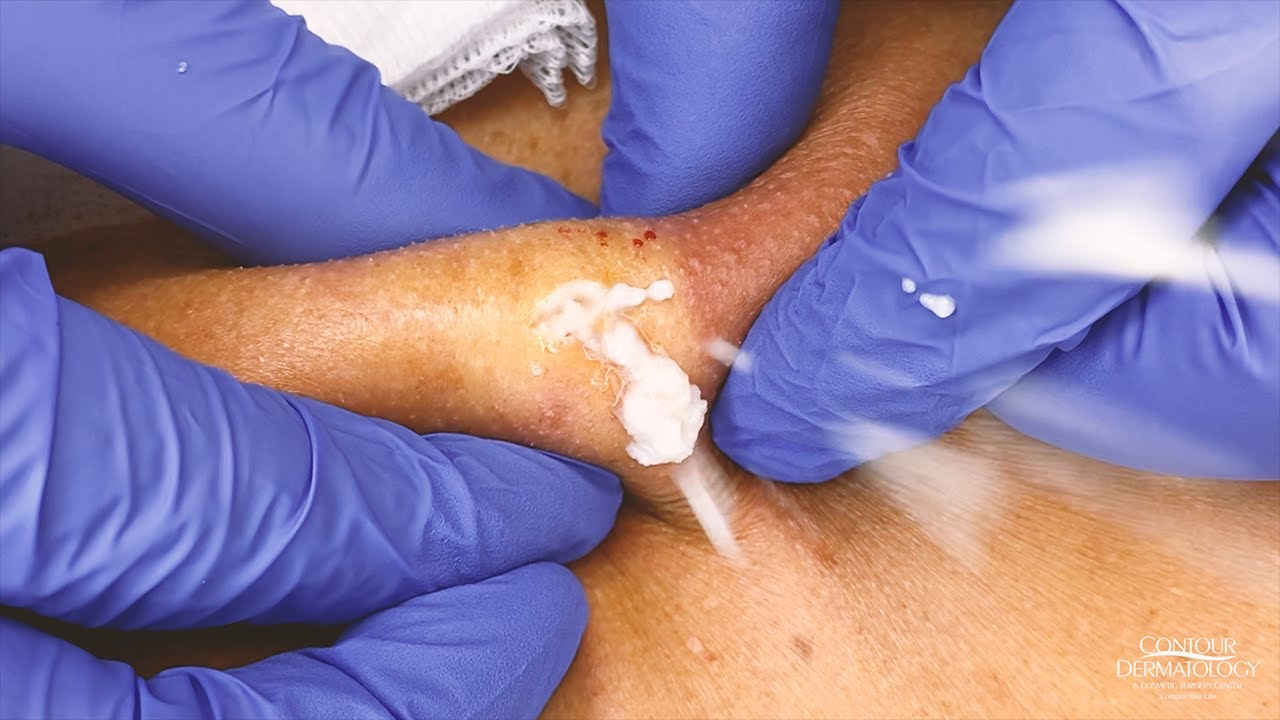 M.A. Thinks This Cyst "looks like a MILKSHAKE!" | Contour Dermatology