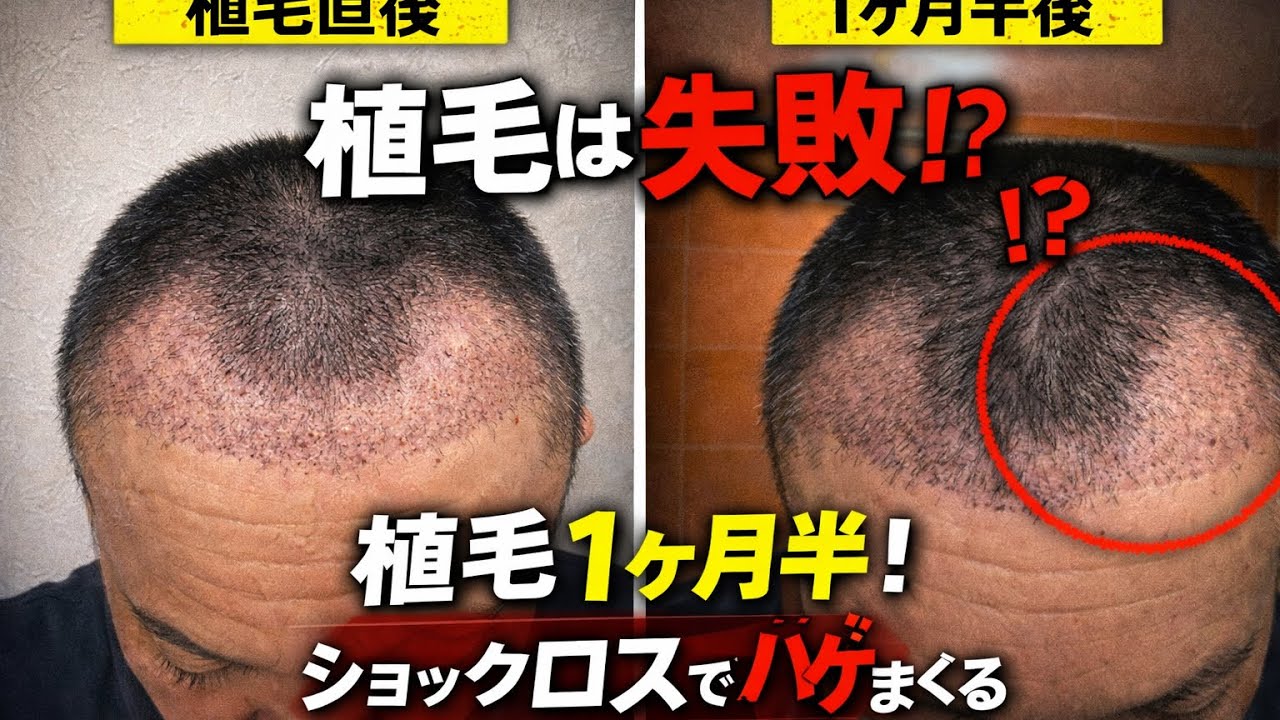 植毛１ヶ月半！ショックロスでハゲまくる