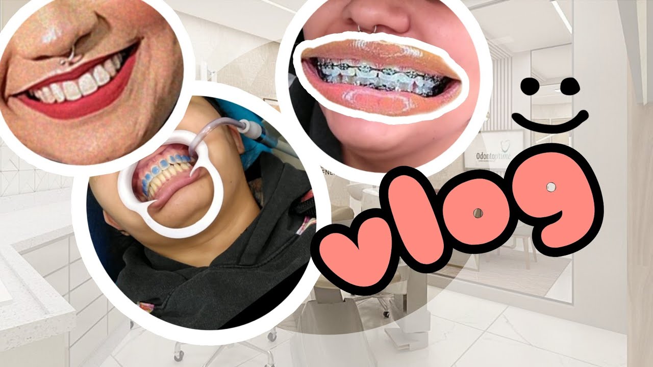 Coloquei aparelho Ortodôntico de novo *VLOG*