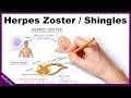 Herpes Zoster/Shingles Symptoms, Diagnosis, Treatment