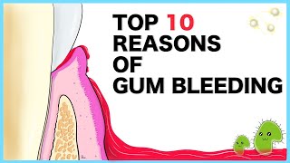 Gum Bleeding: Top 10 causes screenshot 1