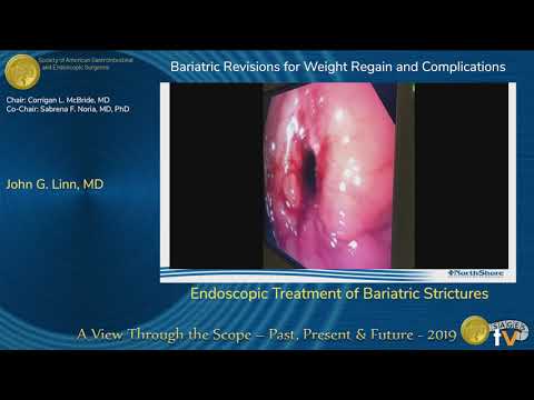 Endoscopic Treatment of Bariatric Strictures