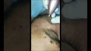 Verrucca plana treatment on face by needle Cautery