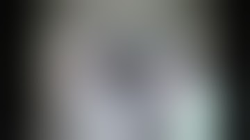 SMALL INCISION CATARACT SURGERY (SICS) - Dr Saurav Piya