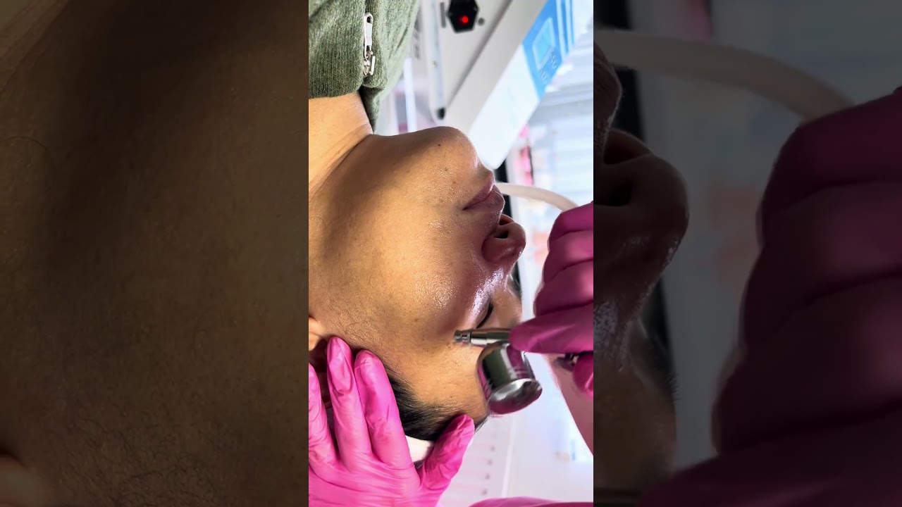 Non-surgical facelift | Skin Tightening | Natural Skinn