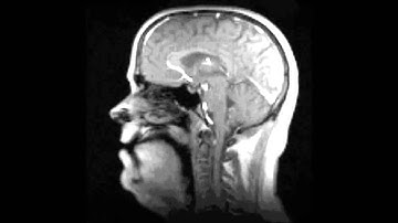Fast MRI technique captures neuromuscular movements in real time
