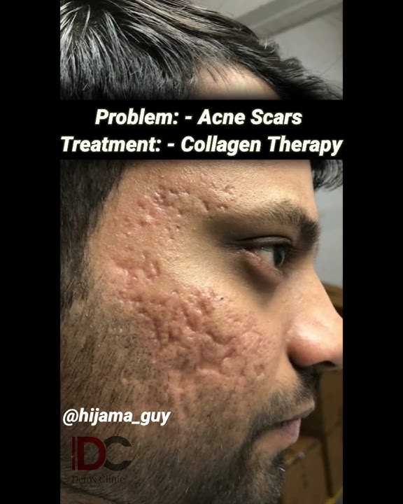 Successful Treatment Of Acne Scars  #acne #scars #openporesremedy #boxerscars #scarstreatment #skin