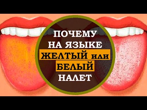 Почему на языке белый  или желтый налёт. Факты про тело человека