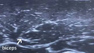 muscle contraction in sonography