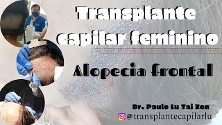 Sou mulher posso fazer transplante capilar feminino ? #alopecia #androgenética #redução #testa