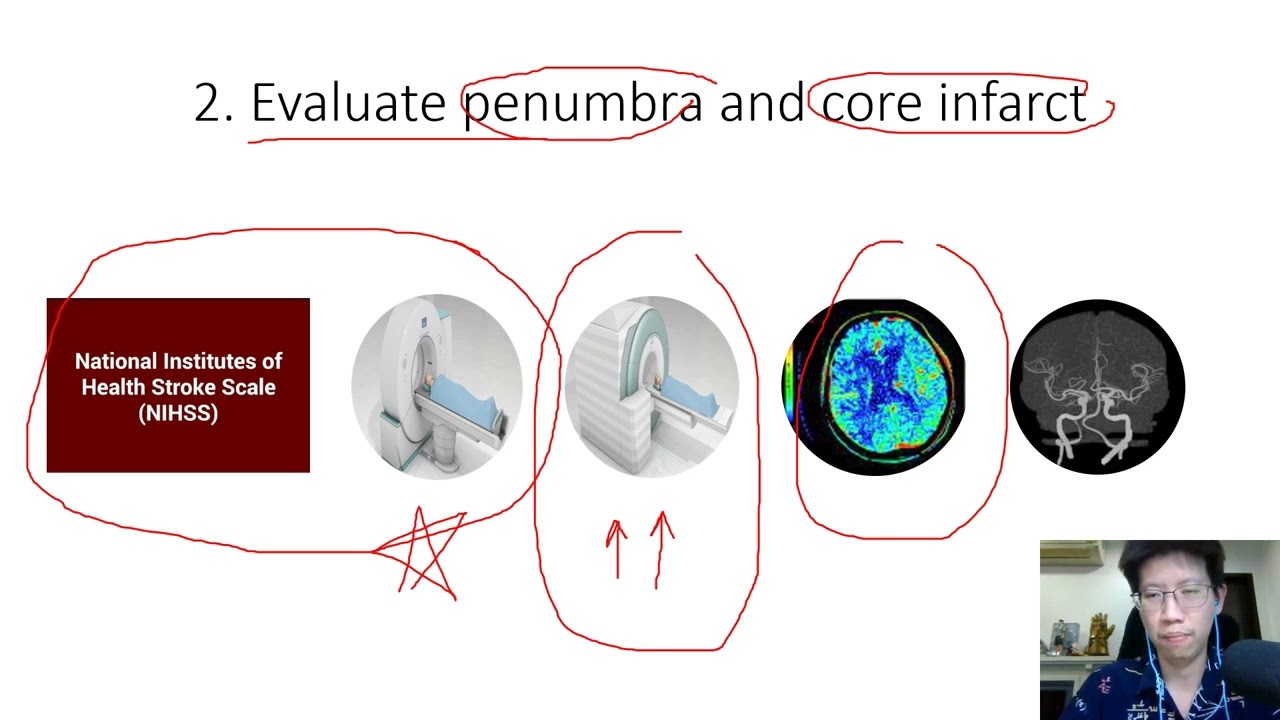 Acute stroke management 2022