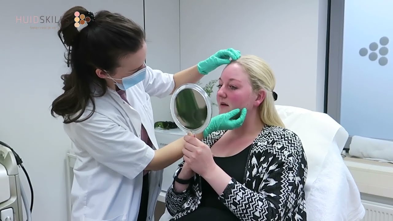 Laserbehandeling van Rosacea, Couperose of roodheid bij Huidskills Dordrecht