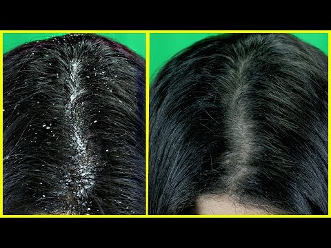Just 1 Wash To Get Rid Of Dandruff Permanently - Home Remedy To Remove Dandruff
